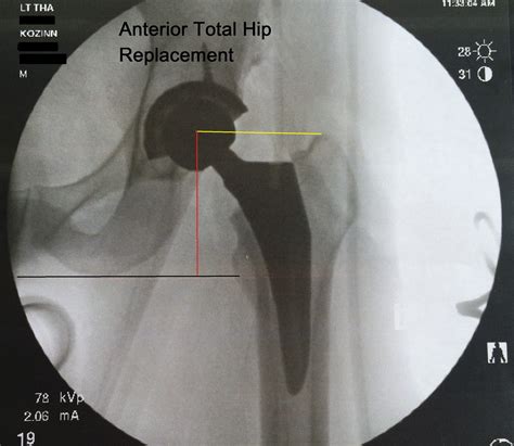 Anterior Hip Replacement Recovery Timeline | Renew Physical Therapy