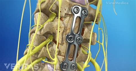 Anterior Cervical Corpectomy Procedure | Ilyas Munshi | Tumblr