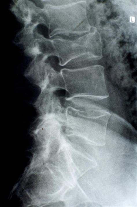 Ray Osteoporosis Images, Osteoporosis X-ray Pictures | Health Photos Gallery | Pinterest | X ...