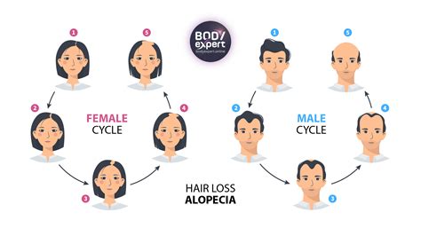 Norwood-Hamilton scale: the 7 stages of male pattern baldness