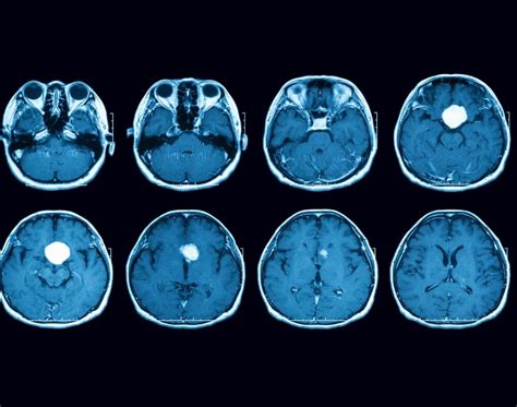 Pick’s Disease and Connection with Dementia - ReaDementia