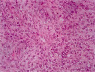 Histology of the lesion suggestive of rhabdomyosarcoma at 200×... | Download Scientific Diagram