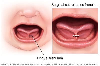 Tongue-tie (ankyloglossia) - Diagnosis and treatment - Mayo Clinic