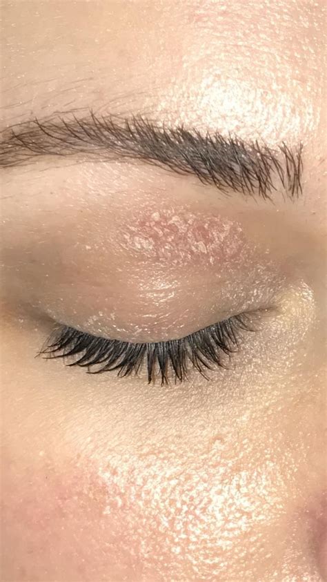 [Skin Concern] What is this patch on my eyelid? How do I treat it? It's dry and stings ...