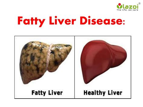 PPT - Fatty Liver Disease: Information on symptoms, causes and treatment PowerPoint Presentation ...