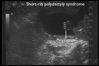 Short rib-polydactyly syndrome; Majewski Syndrome; Saldino-Noonan Syndrome