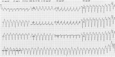 Ventricular Tachycardia Vs Supraventricular Tachycardia