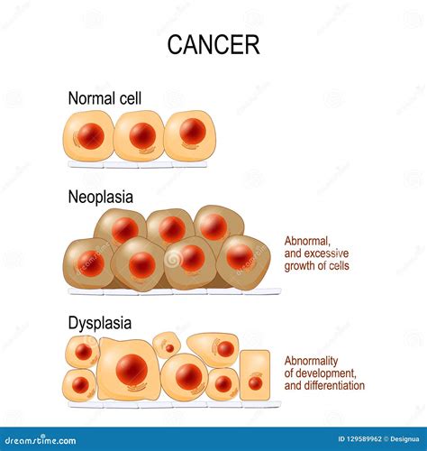 Cancer. Normal Cells, Dysplasia, and Neoplasia Stock Vector - Illustration of division, body ...