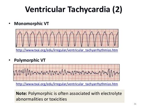 Polymorphic Ventricular Tachycardia Acls