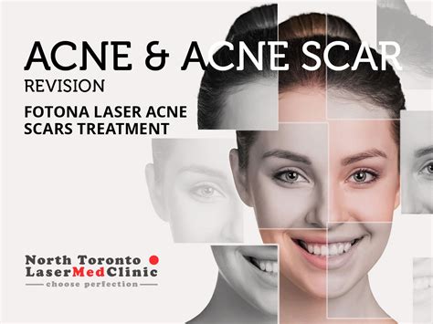 Fotona Laser Acne Scars Treatment | North Toronto Laser Med Clinic