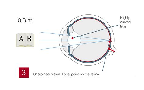 Presbyopia - Correction & Treatment at Test Winner EuroEyes