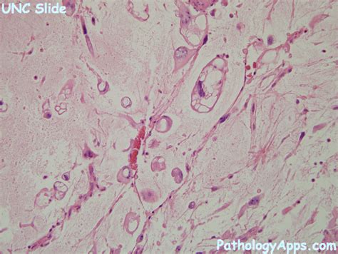 myxofibrosarcoma bone, soft tissue histology