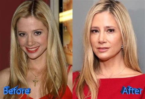 Mira Sorvino Plastic Surgery: Rumors and Gossips About It