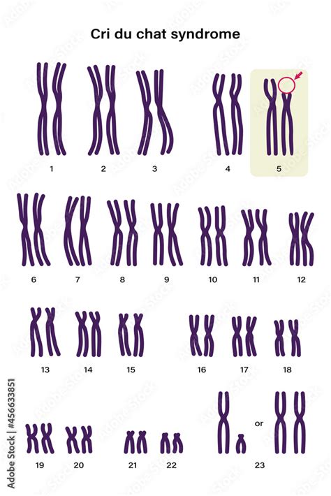 Human karyotype of Cri du chat syndrome. Autosomal abnormalities. A piece of chromosome 5 is ...