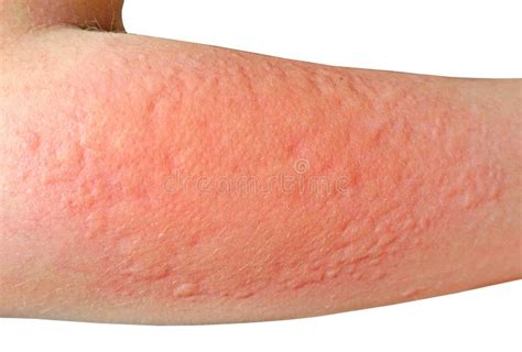 Allergic Contact Dermatitis At Shin Stock Image - Image of care, elbow ...