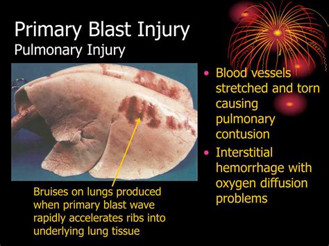 PPT - Evaluation and Treatment of Blast Injuries PowerPoint Presentation - ID:1223861