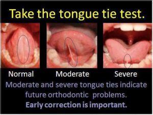 Tongue Tie – Innovative Myofunctional Therapy