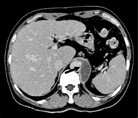 Abdominal CT scan image shows a low attenuation lesion (arrow), about ...