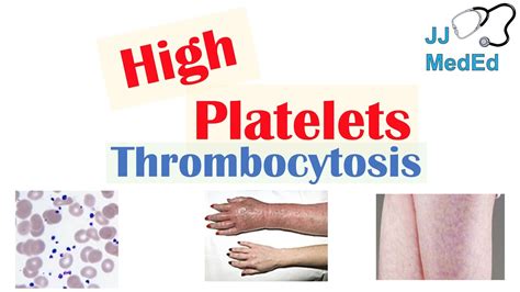 What Causes High Platelets (Thrombocytosis) | Approach to Causes ...