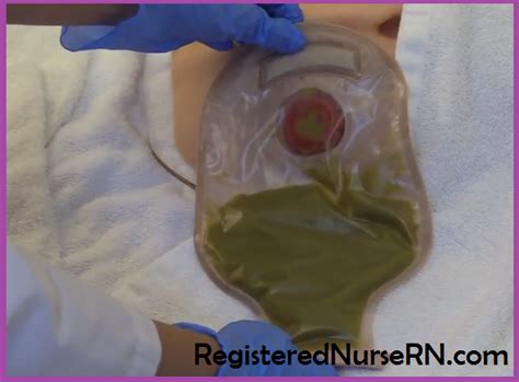 How to Change an Ostomy Bag for Nurses