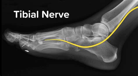 HD - Posterior Tibial Nerve Block | EM:RAP