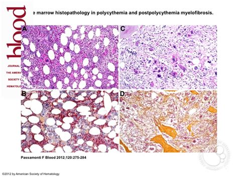 Bone marrow histopathology in polycythemia and postpolycythemia myelofibrosis