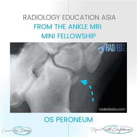 ANKLE MRI OS PERONEUM: WHAT IS THE DX - Radedasia