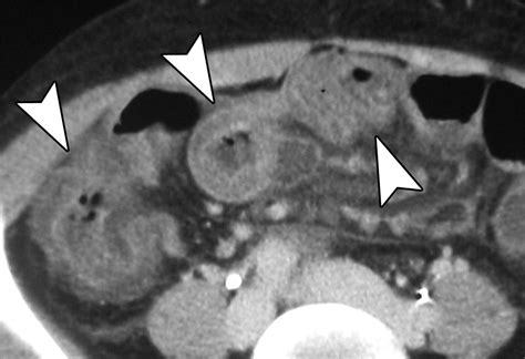 CT Diagnosis of Acute Mesenteric Ischemia from Various Causes | AJR