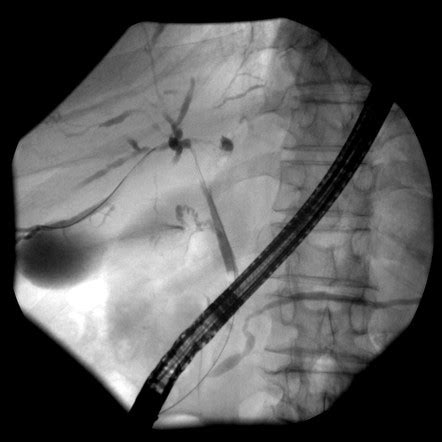 IgG4-related sclerosing cholangitis | Radiology Reference Article | Radiopaedia.org