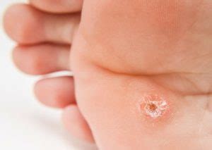 Hyperkeratosis: What is it? Causes, Types, Symptoms and Treatment - Scope Heal