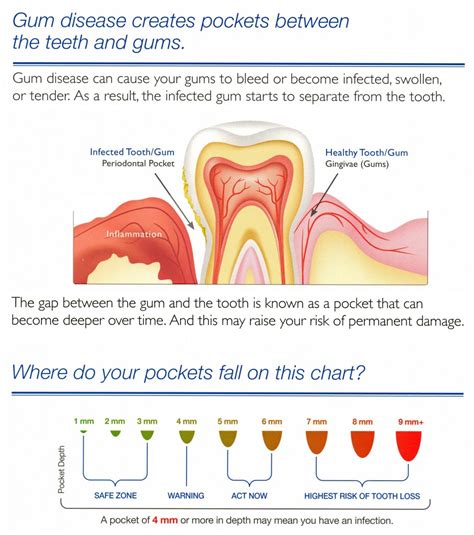 What Is Periodontal Charting? - Matthews Periodontics