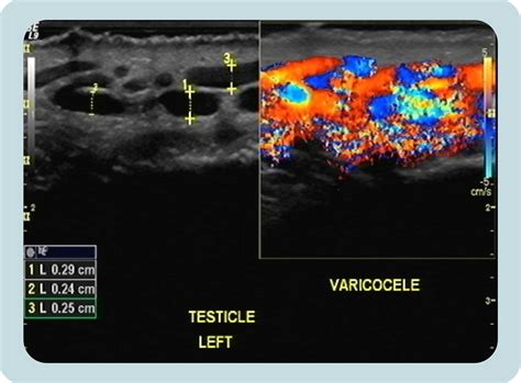 Causes & Treament of Varicocele | Georgiadis Urology