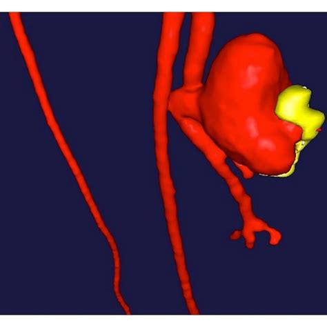 CT angiogram showing the left profunda femoris artery pseudoaneurysm. | Download Scientific Diagram