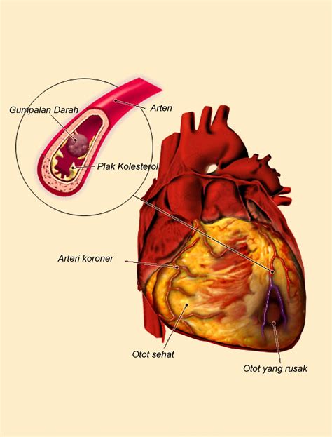 dr. Ferry Fawzi Annor: Acute Myocard Infark