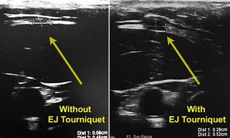 Trick of the Trade: External jugular tourniquet