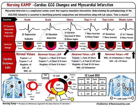 12 Lead Stemi Chart