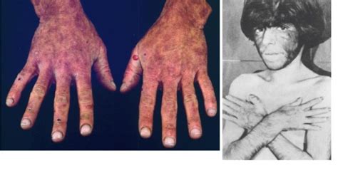 Chronic cutaneous porphyrias - Dermatology Advisor