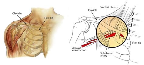 Thoracic Outlet Syndrome - Brian Waterman, MD