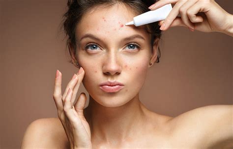 Adult Acne – Causes, Symptoms, And Treatments