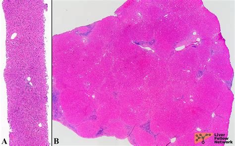 Liver Wedge Biopsy