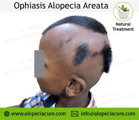 Ophiasis Alopecia Areata