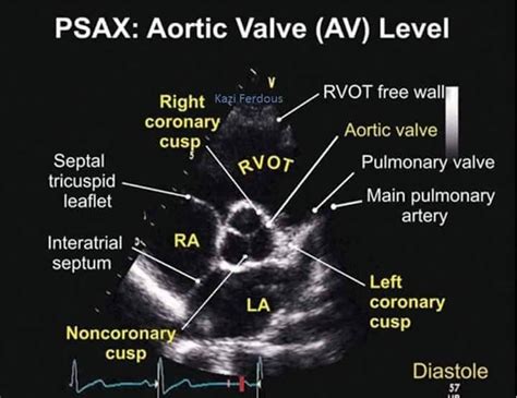 How to do Echocardiography | Standard Protocol for Performing ...