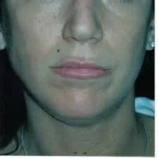 Lip Reduction/ Cheiloplasty in Kochi by Specialists Hospital | ID: 7172901255