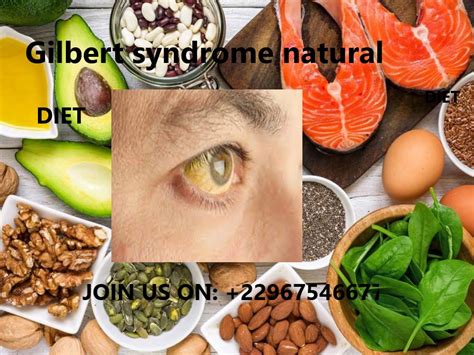 Gilbert syndrome natural diet.eat regularly and not skip meals