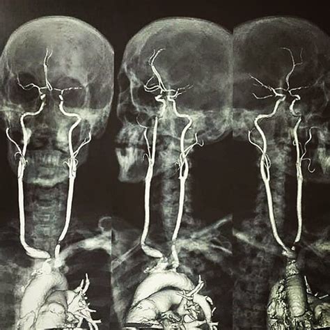 Here is an contrasted MRI showing the origin, length & circulation of the carotid arteries!! : r ...