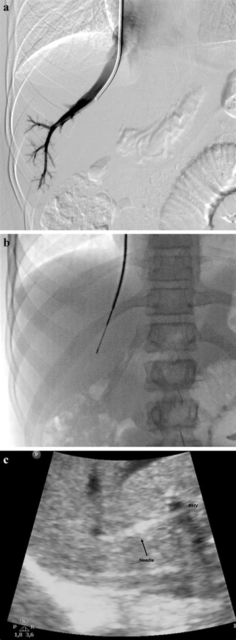 Transjugular liver biopsy in a 9-year-old girl. a Angiography... | Download Scientific Diagram