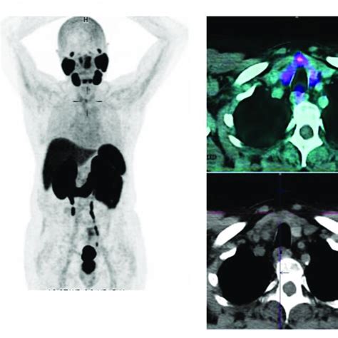 Incidental findings of thyroid cancer in a 63-year-old patient studied ...