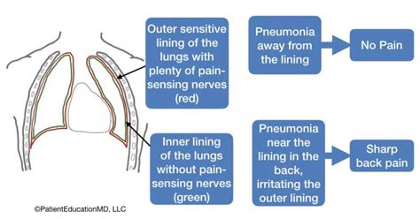 Back pain from pneumonia - PatientEducationMD