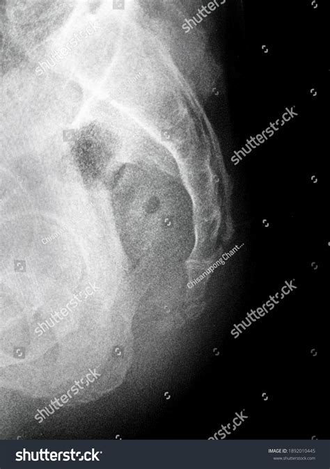 NBrowardRadiologists On X: #Pelvic #Xray Shows A #tail, 60% OFF