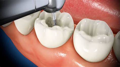 How an Endodontist Can Save You With Tooth-saving Root Canal Procedure | West Cobb Dentistry